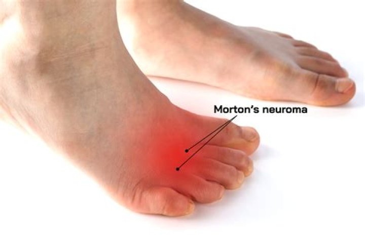 Can a podiatrist treat Morton's neuroma?