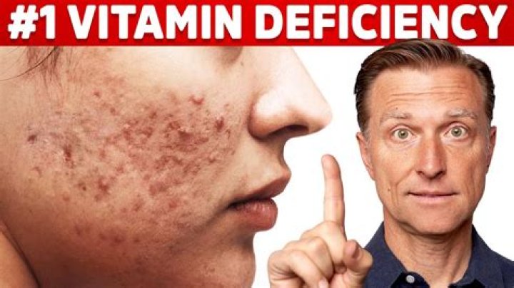 Can a vitamin D deficiency cause acne?