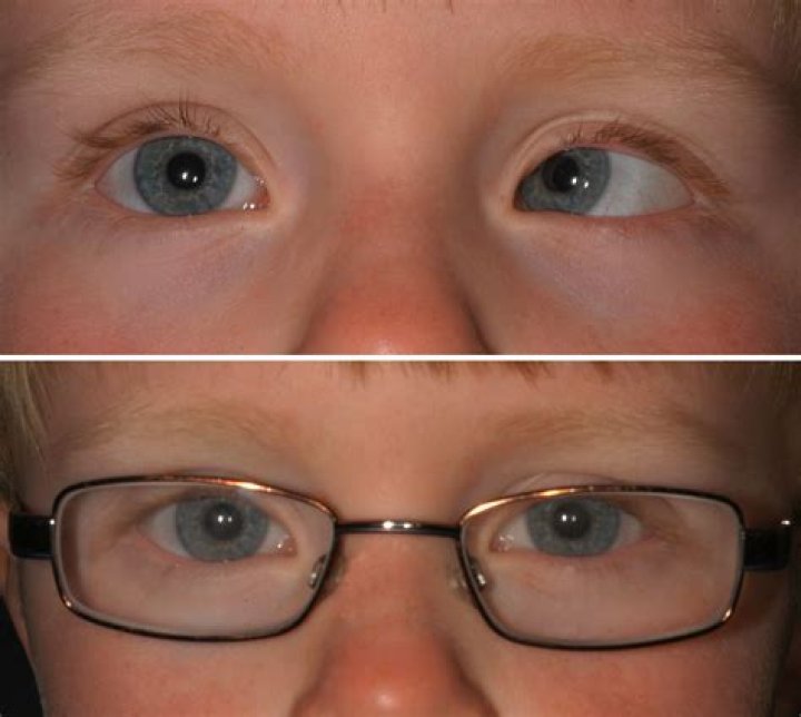 Can accommodative esotropia be fixed?