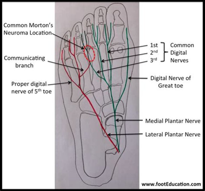 Can Morton's neuroma go away?