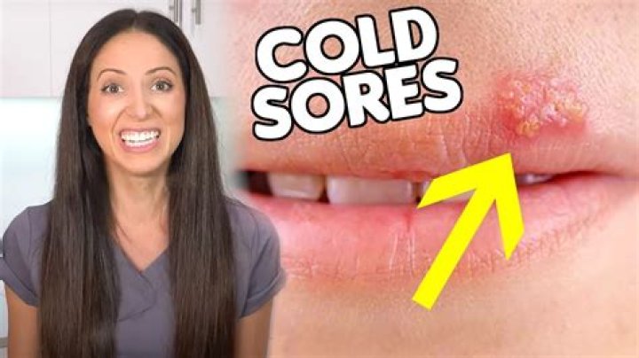 Can spicy food give you cold sores?