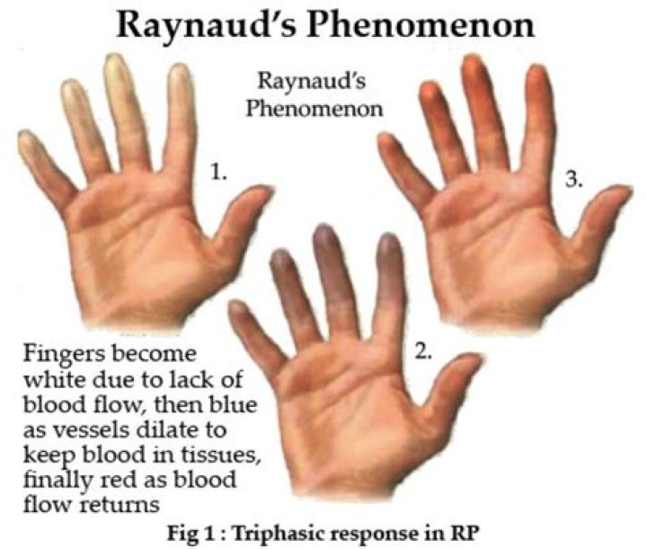 Can you lose your fingers from Raynaud's?