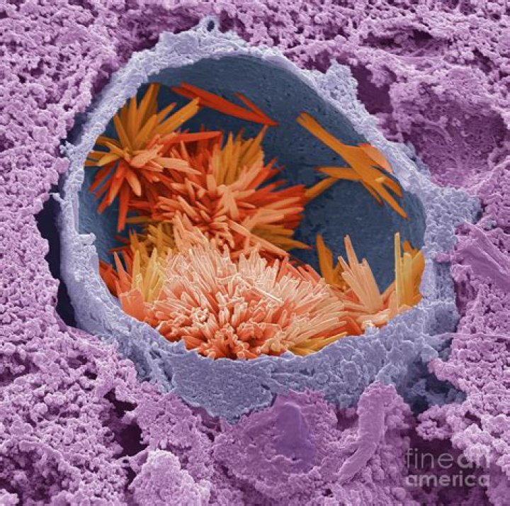 Do cholesterol crystals polarized?