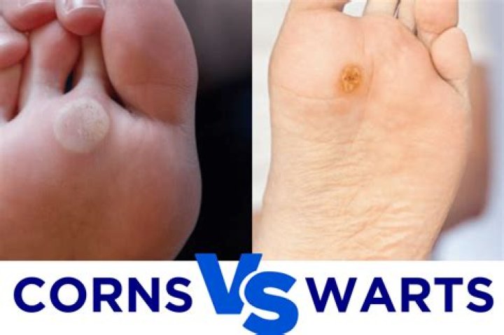 Do corn plasters work on warts?
