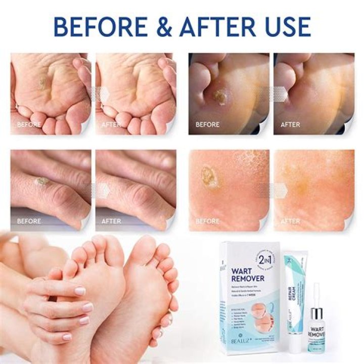 Does salicylic acid burn on warts?