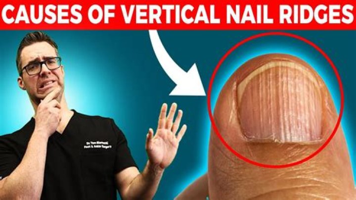 How do I get rid of vertical ridges on my nails?