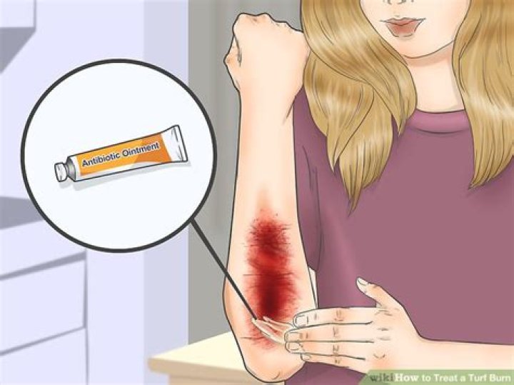 How do you treat turf burn?