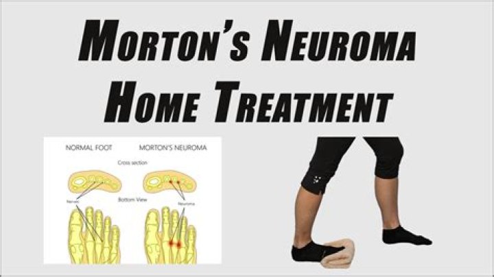 How I cured my Morton's neuroma?