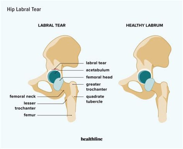 How is a labral tear diagnosed?