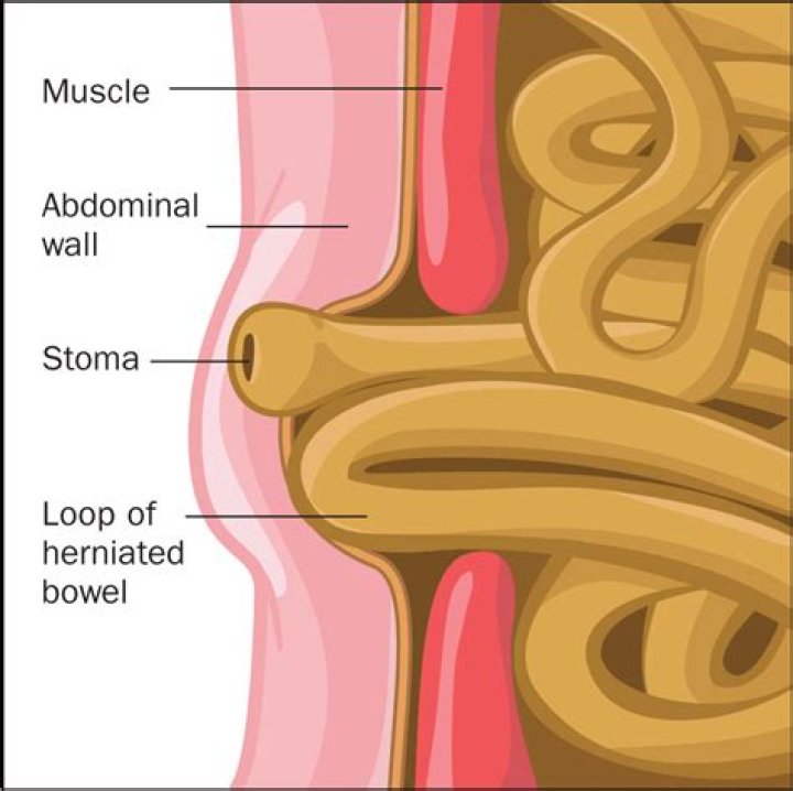 How is a Parastomal hernia treated?