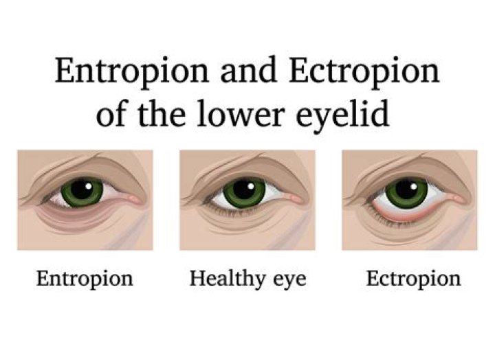 How is ectropion treated?