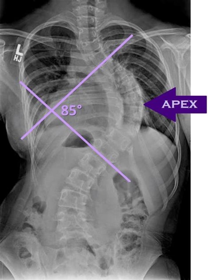 How is scoliosis curve measured in radiology?
