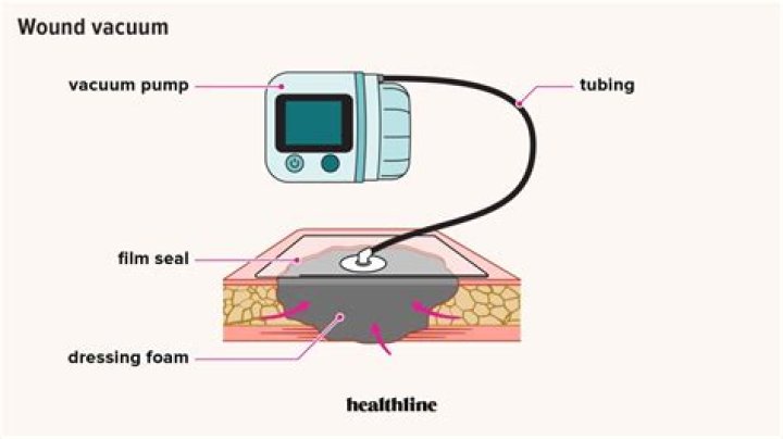 How often should Wound Vac be changed?
