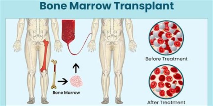 How successful is a bone marrow transplant?