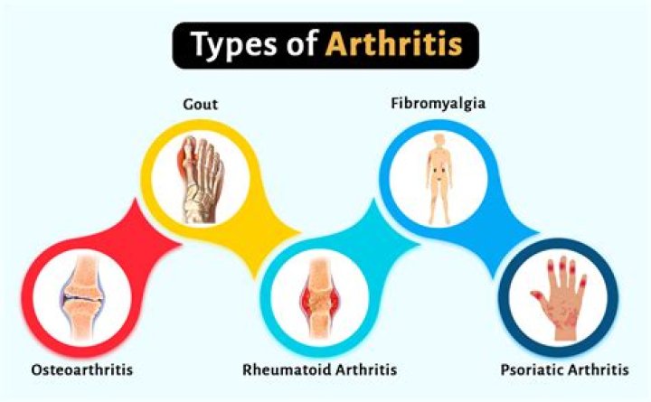 Is dish a form of arthritis?