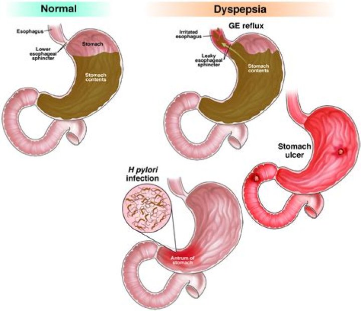 ¿Qué es la dispepsia intestinal?
