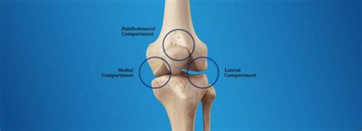 What are Tricompartmental osteophytes?