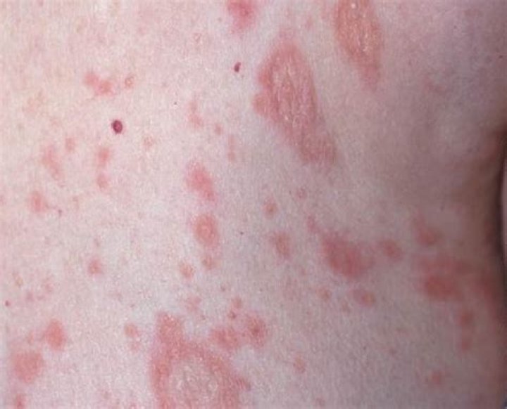 What can be mistaken for pityriasis rosea?