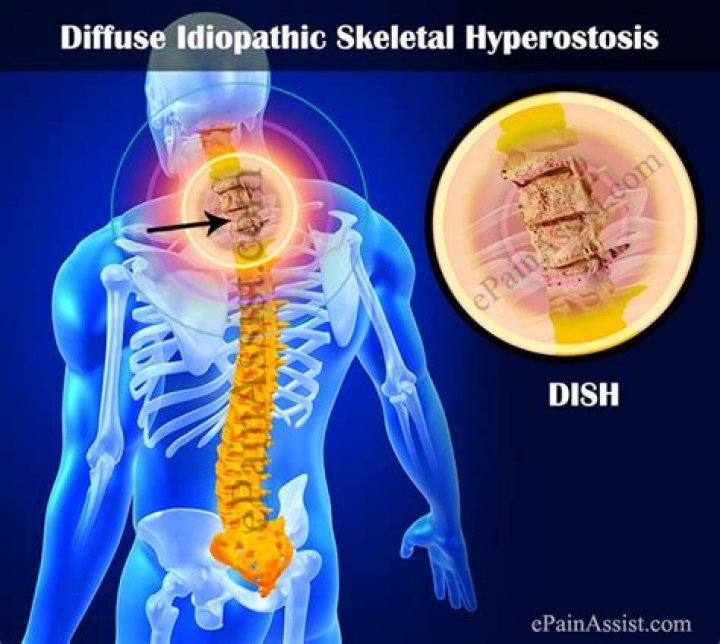 What causes dish syndrome?