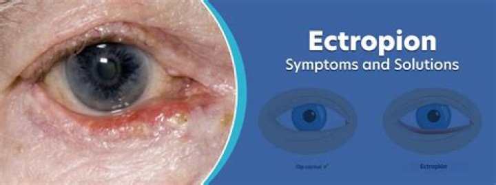 What Causes Ectropion?