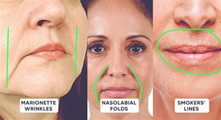 What causes nasolabial folds?