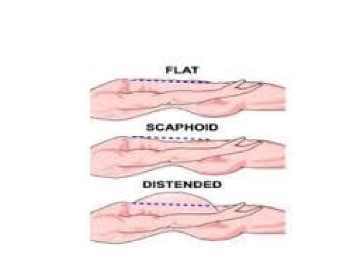 What causes scaphoid abdomen?