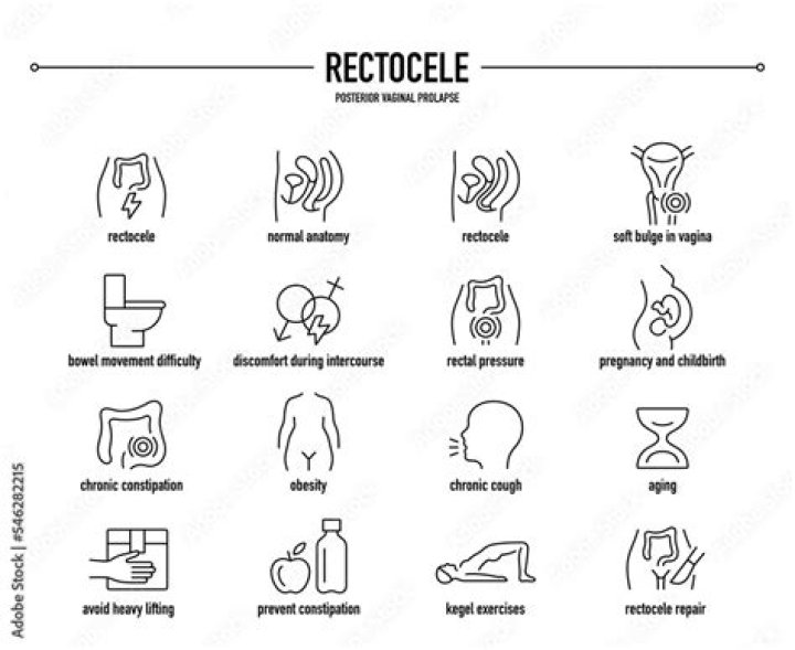 What does a Rectocele look like?