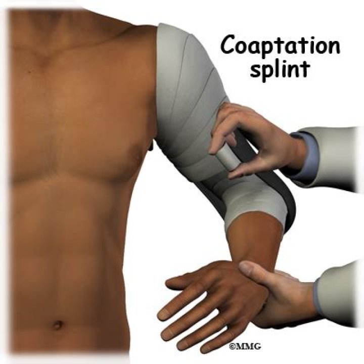 What is a coaptation splint?