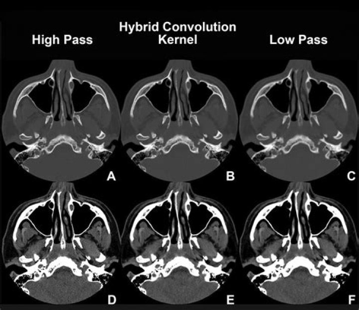 What is a CT kernel?