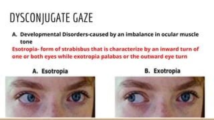 What is a Disconjugate gaze?