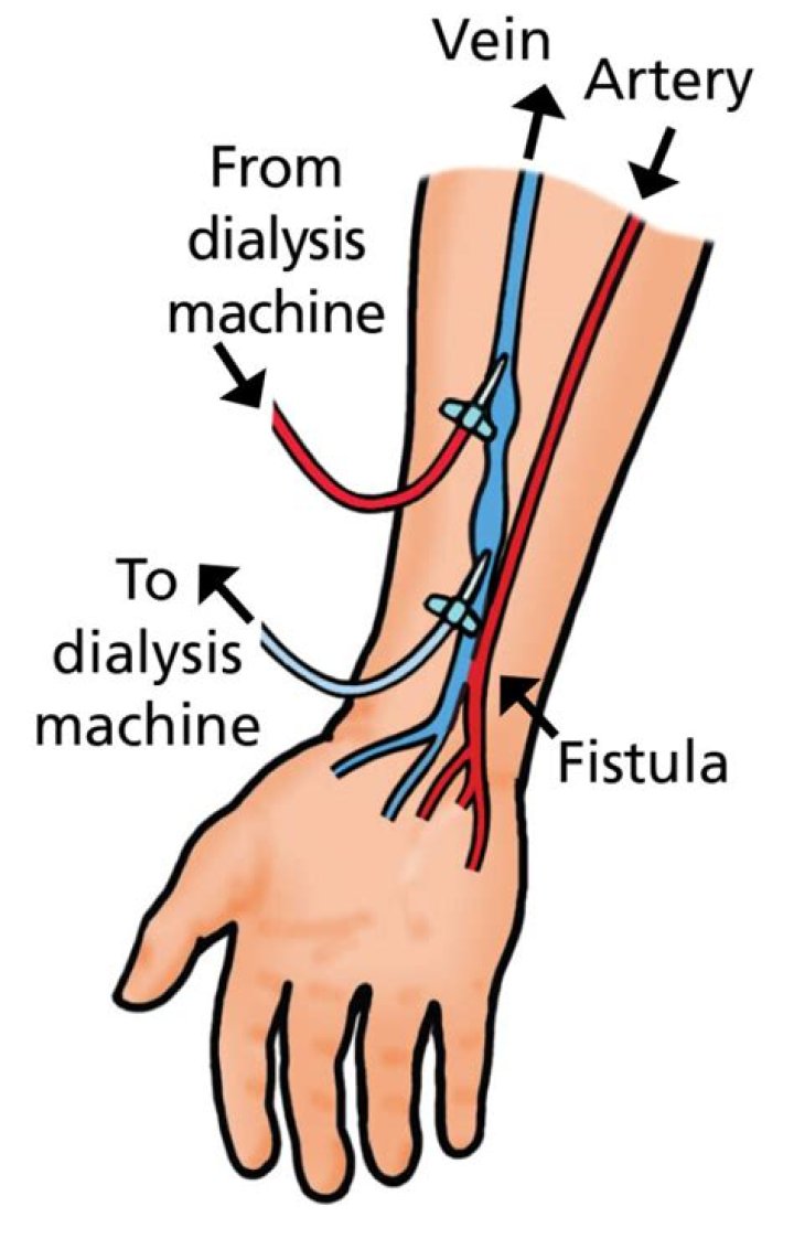 What is a fistula for dialysis?