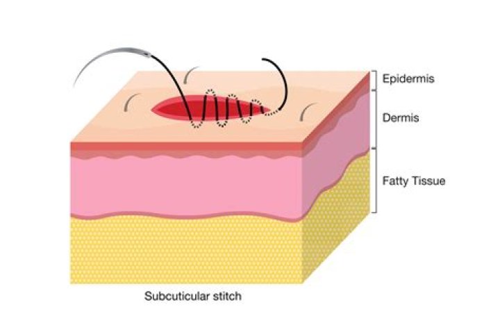 What is a Subcuticular suture?