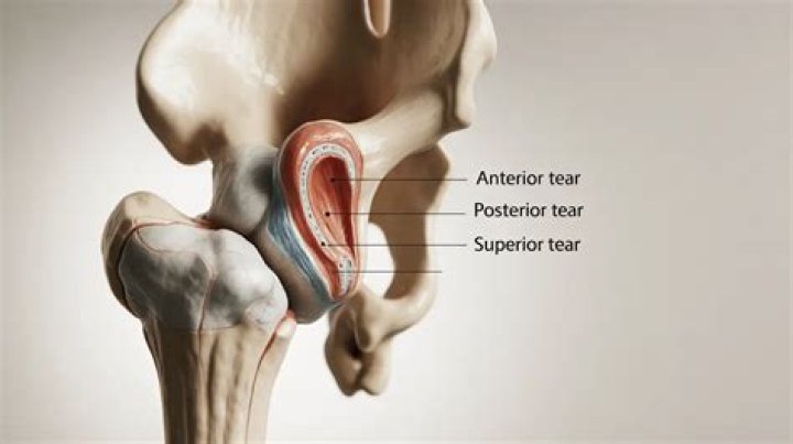 What is an anterior superior labral tear?