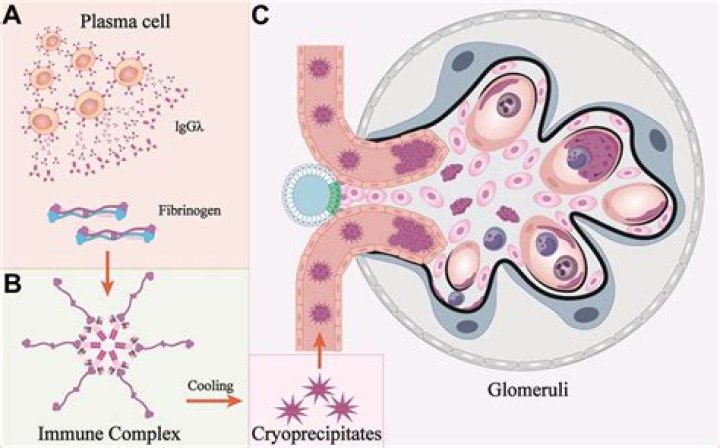 What is immune complex deposition?