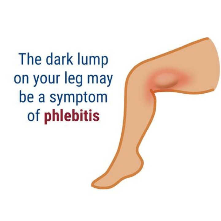 What is phlebitis in the leg?