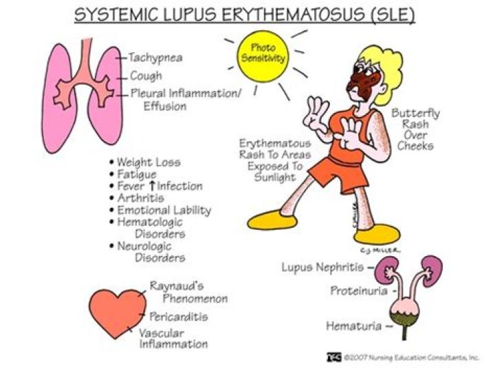 What is Systemic Lupus Erythematosus quizlet?