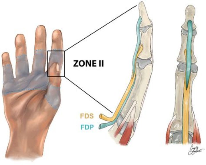What is the FDP tendon?