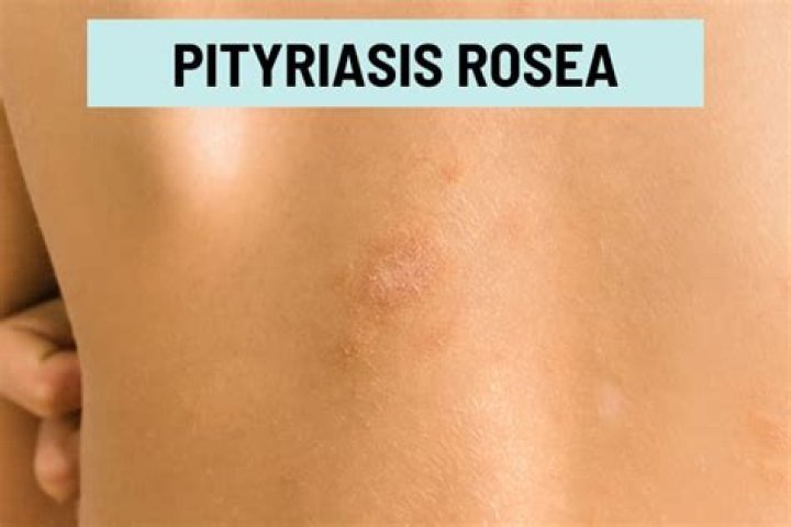 What rash looks like pityriasis rosea?