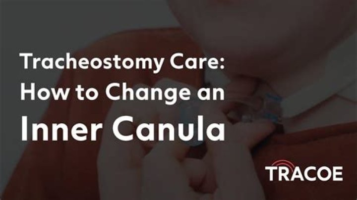 When should the inner cannula of a tracheostomy be removed?