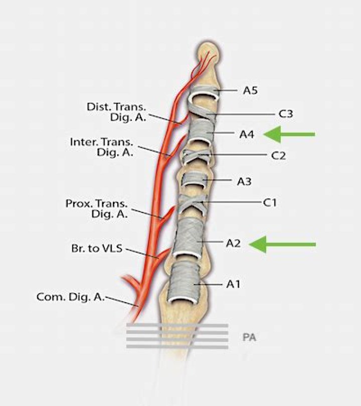 Which complication is most common after 2 stage flexor tendon and pulley reconstruction?
