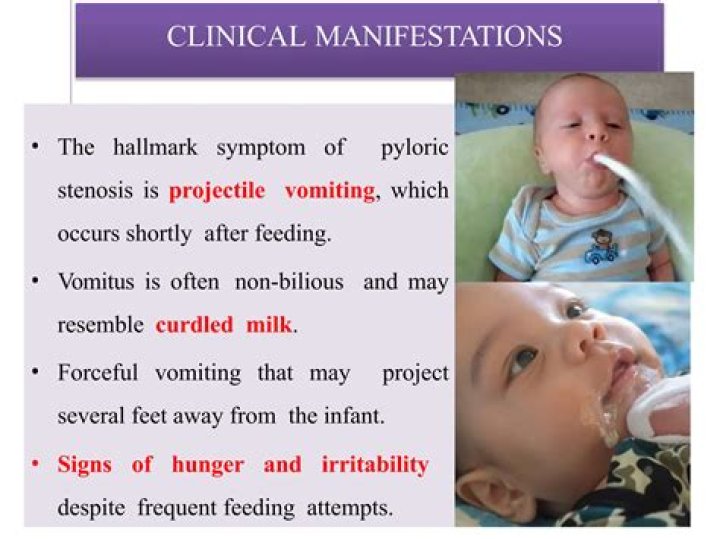 Why does pyloric stenosis occur?